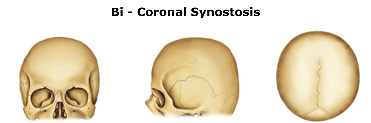 Bi-Coronal Synostosis