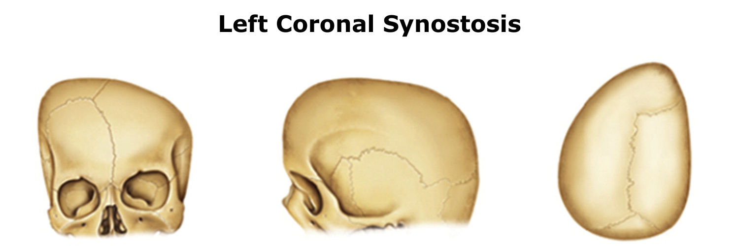 Left Coronal Synostosis