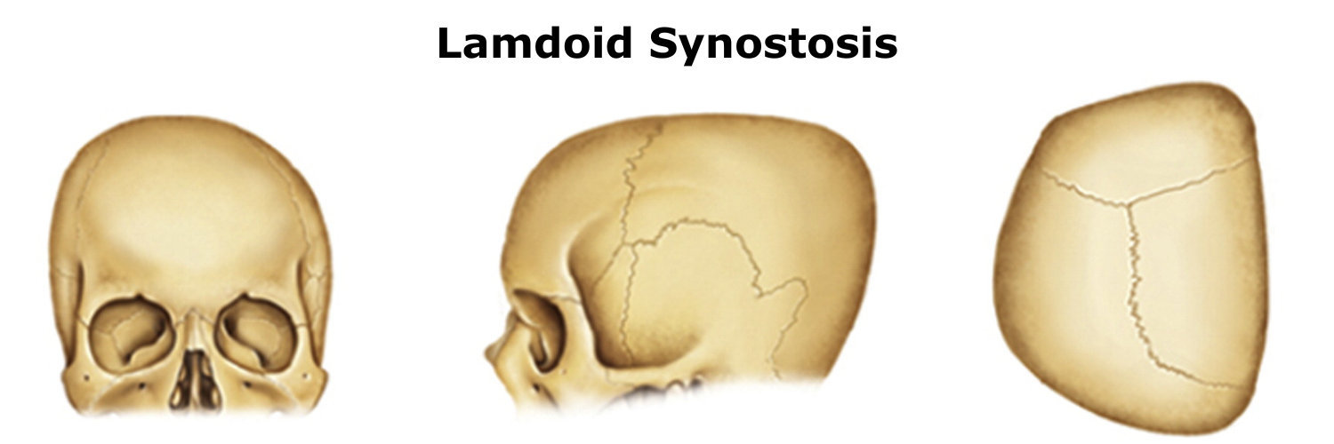 Lambdoid Synostosis