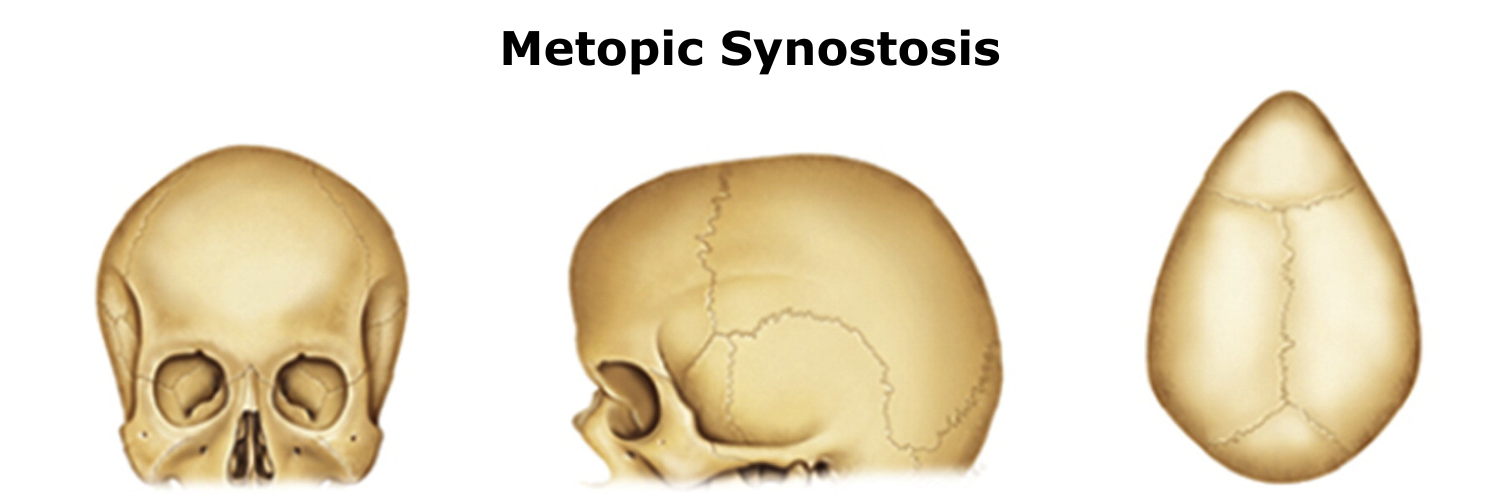 Metopic Synostosis