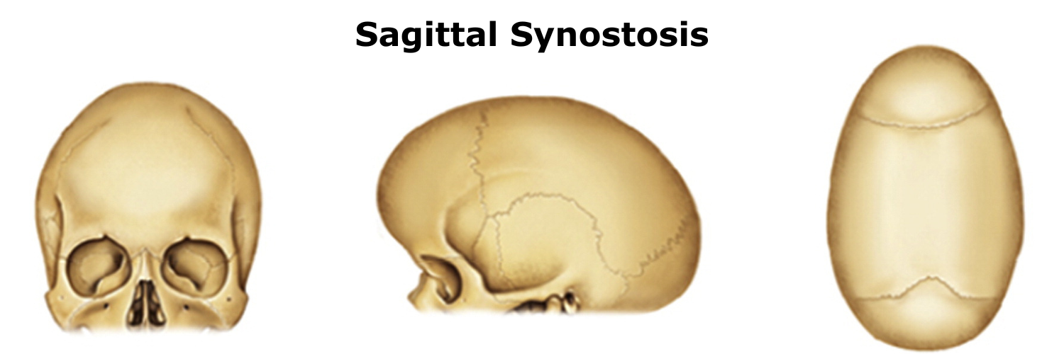 Sagittal Synostosis